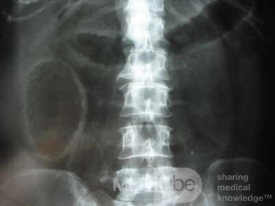 Multiple Rectal Ulcers (37 of 110)