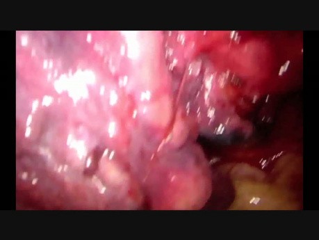 Anomalous Superior Pulmonary Vein Running Underneath Bronchus Intermedius