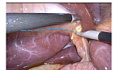 10 Pitfalls Point to Minimize Bile Duct Injuries During Laparoscopic Cholecystectomy