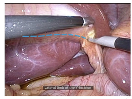 10 Pitfalls Point to Minimize Bile Duct Injuries During Laparoscopic Cholecystectomy