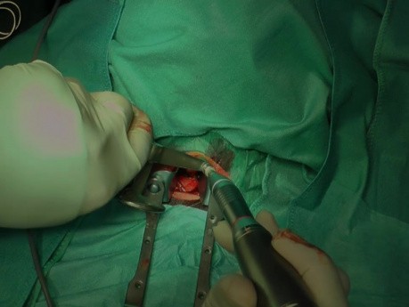 Stenosis of the Cervical Spine