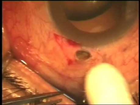 Glaucoma surgery