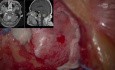 Resection of Metastatic Tumour in the Right Cerebellar Hemisphere
