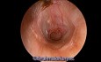 Chronic Suppurative Otitis Media (CSOM) with Pus Discharge from Middle Ear
