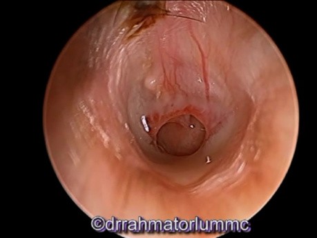 Chronic Suppurative Otitis Media (CSOM) with Pus Discharge from Middle Ear