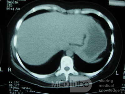 Esophagus - Pneumatic Dilation for Achalasia (27 of 31)