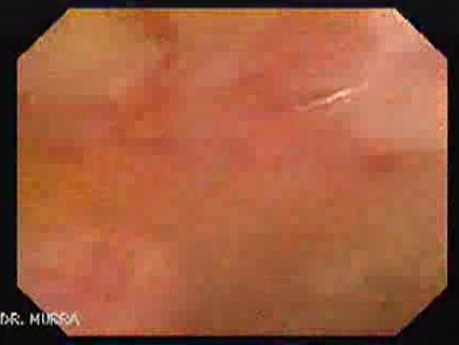 Colonic Tuberculosis Mimicking Crohn's Disease (10 of 12)
