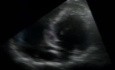 Hypertrophic Cardiomyopathy Echo Case