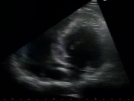 Hypertrophic Cardiomyopathy Echo Case