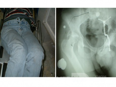 Acute Traumatic Posterior Hip Dislocation