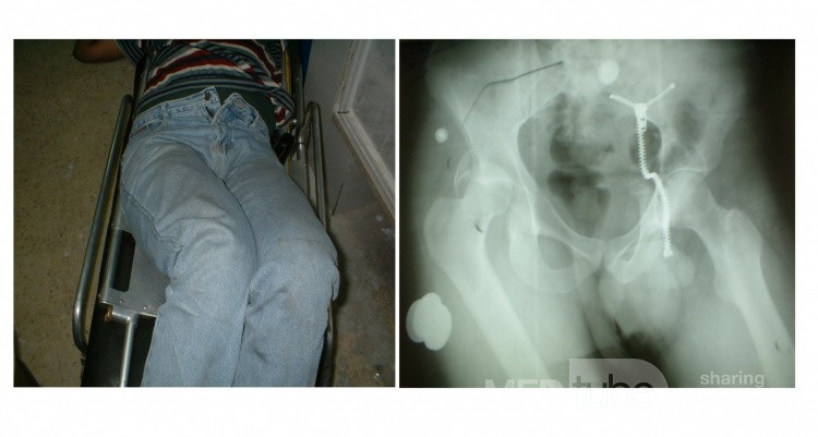 Acute Traumatic Posterior Hip Dislocation