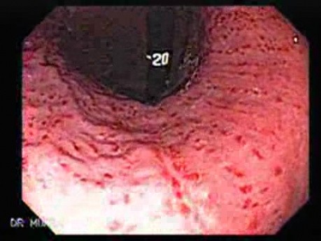 Acute Gastritis (Pangastritis) (6 of 10)