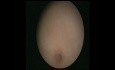 Normal Hysteroscopy