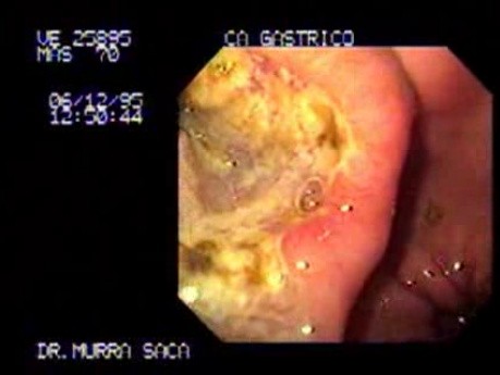 Ulcerative Adenocarcinoma of the Gastric Body - Endoscopy 2