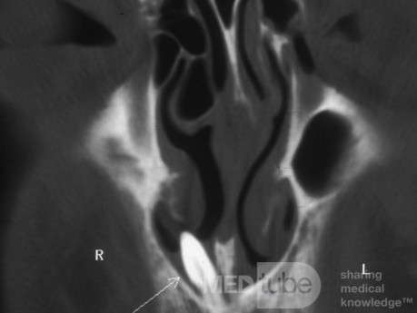 Tooth Projecting through Floor of the Nasal Cavity [CT scan]