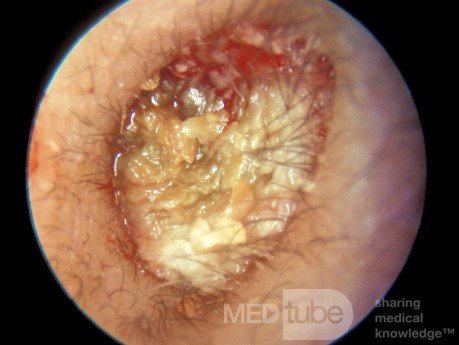 Keratosis Obturans