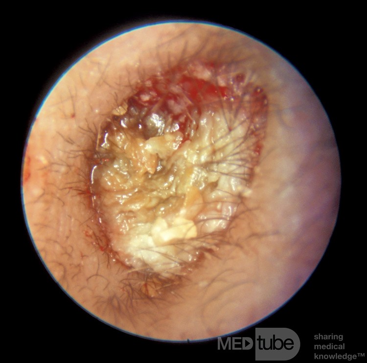 Keratosis Obturans