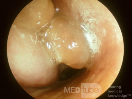 Nasal Polyps And The ASA Triad