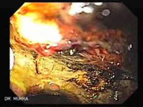 Gastrointestinal Bleeding Caused by Advanced Gastric Carcinoma - Enormous Irregular Ulcer