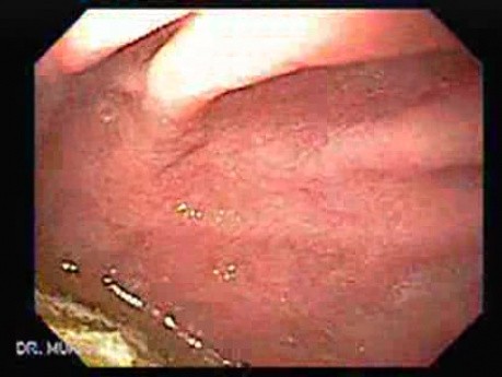 Paraesophageal Hiatal Hernia - 1/2
