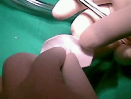 Atrial Septal Defect With Interstitial Lung Disease