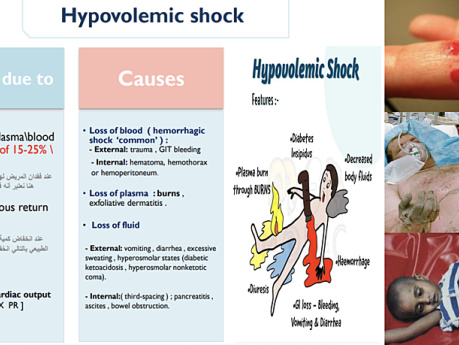 Shock - Types, PP & MGT