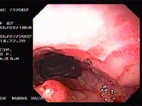 Crohn's Disease - Endoscopy (12 of 28)