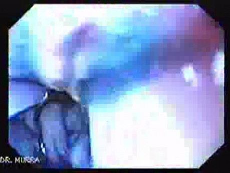 Chromoendoscopy Of The Esophagus - Introducing Methylene Blue