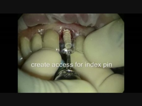 Immediate Implant Provisional