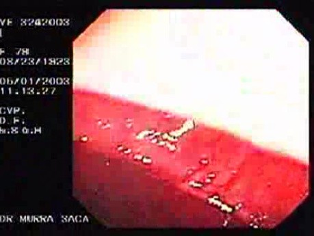 Dieulafoy´s Lesion (Exulceratio Simplex) (4 of 6)