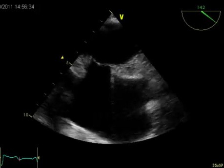 Lipomatous Hypertrophy of the Atrial Septum (LHAS) - Video nr 2