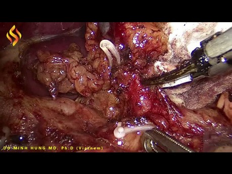 Lap Suprapancreatic Area LNs Dissection for GC