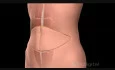 TRAM Breast Reconstruction