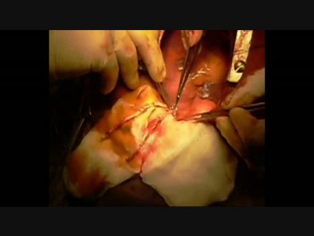 Creation of Composite Y-graft with Bilateral Internal Mammary Arteries for Coronary Grafting