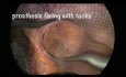 Laparoscopic Parastomal Hernia Repair