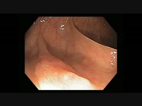 Colonoscopy Channel - Serrated Adenoma With Intramucosal Cancer