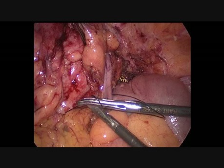 Laparoscopic Sigmoidectomy for Diverticulitis Complicated Colovaginal Fistula