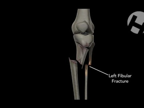 Open Reduction Internal Fixation of Left Tibial Plateau and Shaft Fracture