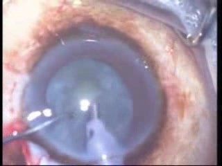 Combined Surgery Phacoemulsification And Trabeculectomy