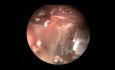 Endoscopic Removal of Infratemporal Fossa Cavernous Hemangioma Through Inferior Meatal Antrostomy