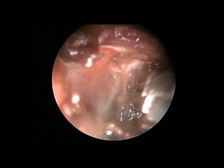 Endoscopic Removal of Infratemporal Fossa Cavernous Hemangioma Through Inferior Meatal Antrostomy