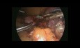 Laparoscopic Gastric Tube Cut