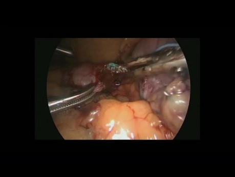 Laparoscopic Gastric Tube Cut