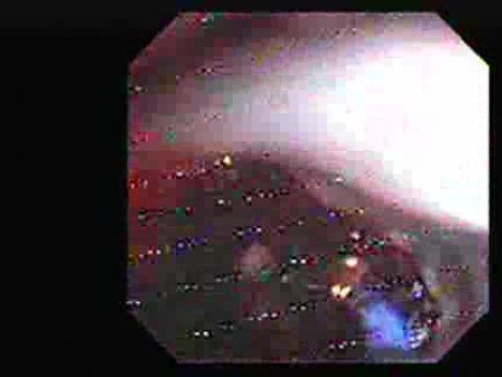 Hemorrhage After Ligation - Light from Argon Plasma Coagulator