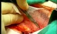 Lichtenstein Procedure - Hernia Repair