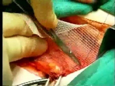 Lichtenstein Procedure - Hernia Repair