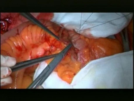 Open Right Hemicolectomy – Technical Principles - Operation No 1 - Part 5