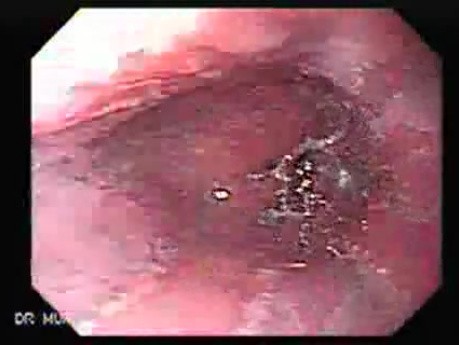 Barrett's Esophagus of long segment (2 of 11)