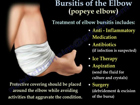 Bursitis Elbow - Video Lecture