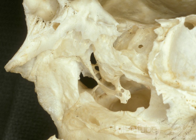 The Uncinate Process [Skeletal Specimen]